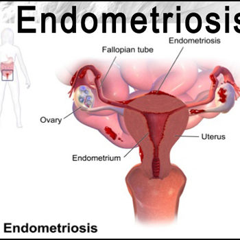 how to treat endometriosis